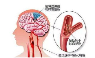 脑梗发作前3个部位可能变硬