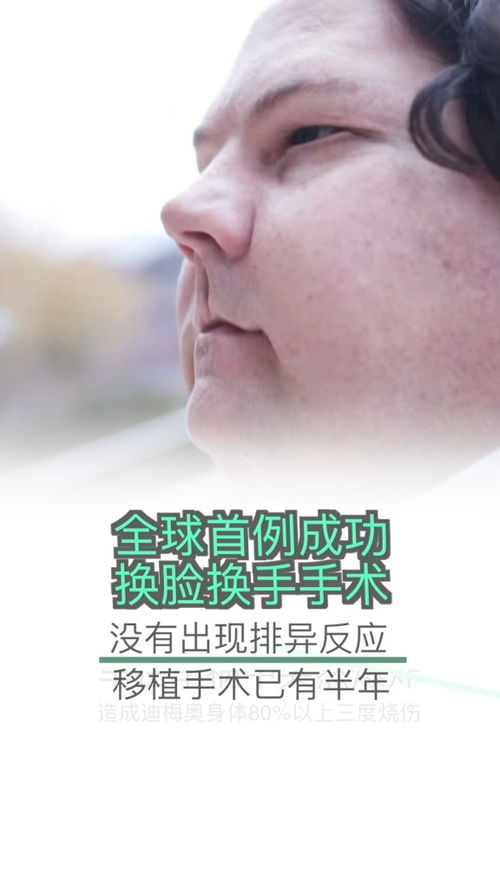 全球首例同时换脸换手男子结婚