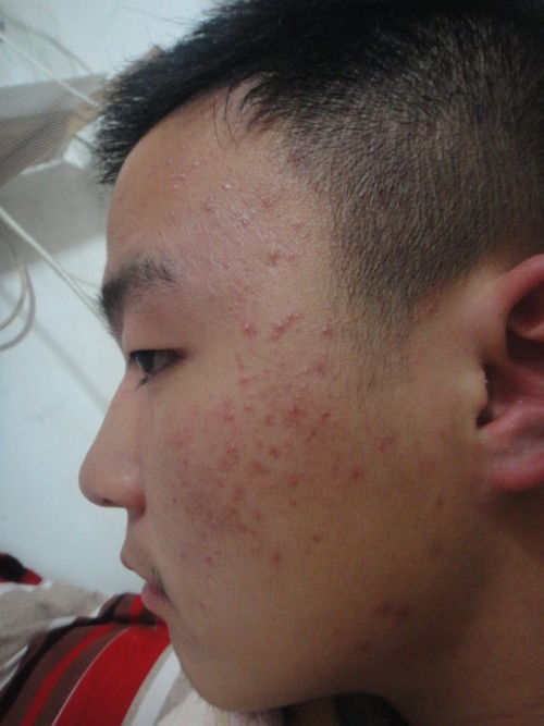 19岁小伙脸上爆痘竟是红斑狼疮