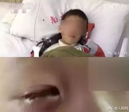 8岁孩子厨房玩刀意外刺破肝脏