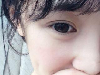 女孩作息黑白颠倒小腿长满紫红色斑