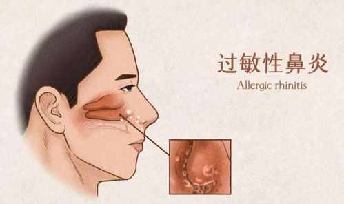 过敏性鼻炎的“幕后黑手”