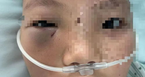 男童在幼儿园被筷子插入鼻子致穿孔