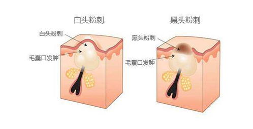 热卖的“挤痘痘”玩具内含针头针管