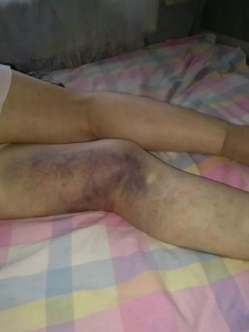 女子被宠物猫咬伤腿部溃烂