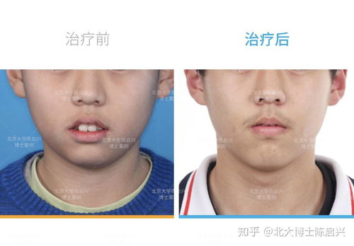 森碟下巴后缩改善了很多